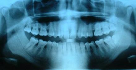 Pierwsze rtg zębów wykonał Otto Walkhoff zaledwie 14 dni po odkryciu promieni X przez Roentgena (1895)