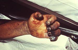 Ręka pacjenta chorego na dżumę